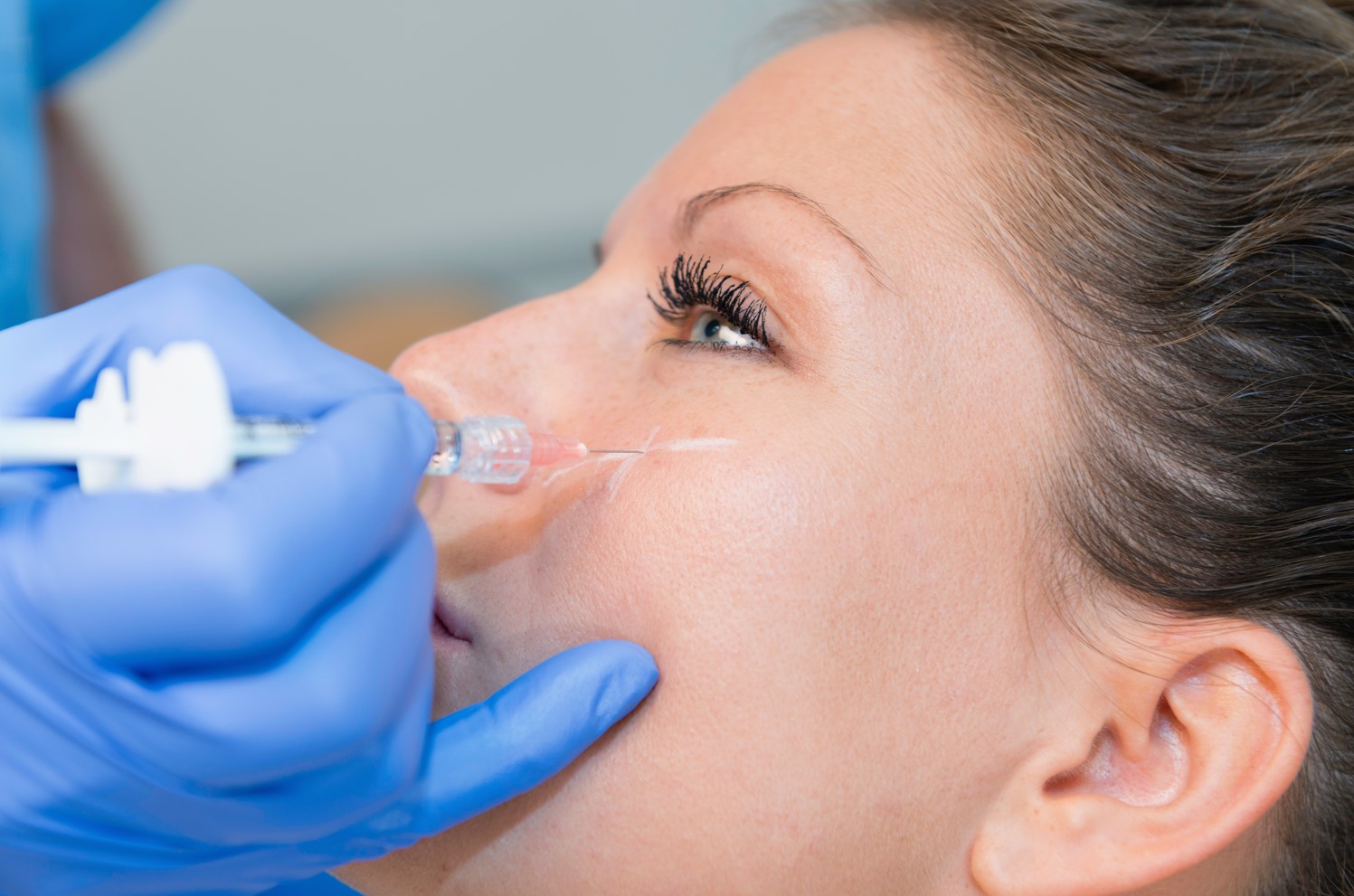 Ácido Hialurónico 1